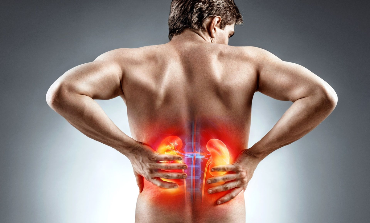 Боль в спине – исключите патологию почек!